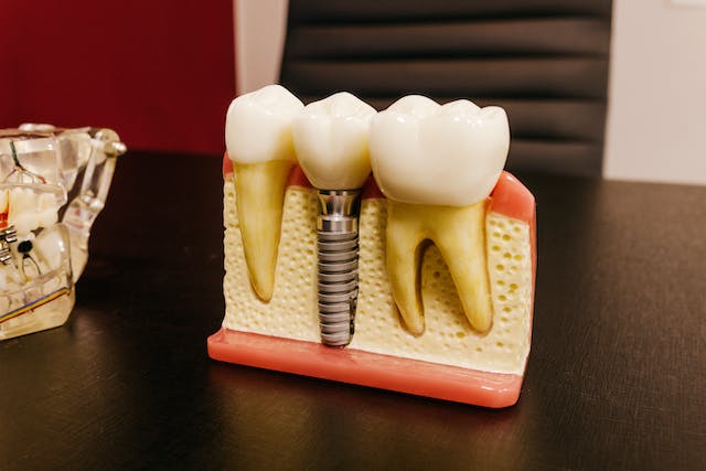 כמה זמן מחזיקים השתלות שיניים תובנות חיוניות